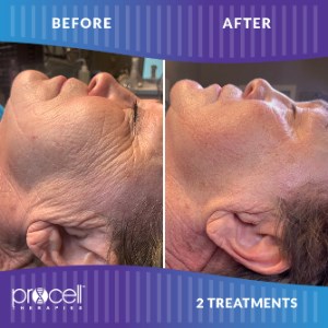 Microchanneling ProCell Facial with Aftercare Kit

 

 
 Photo